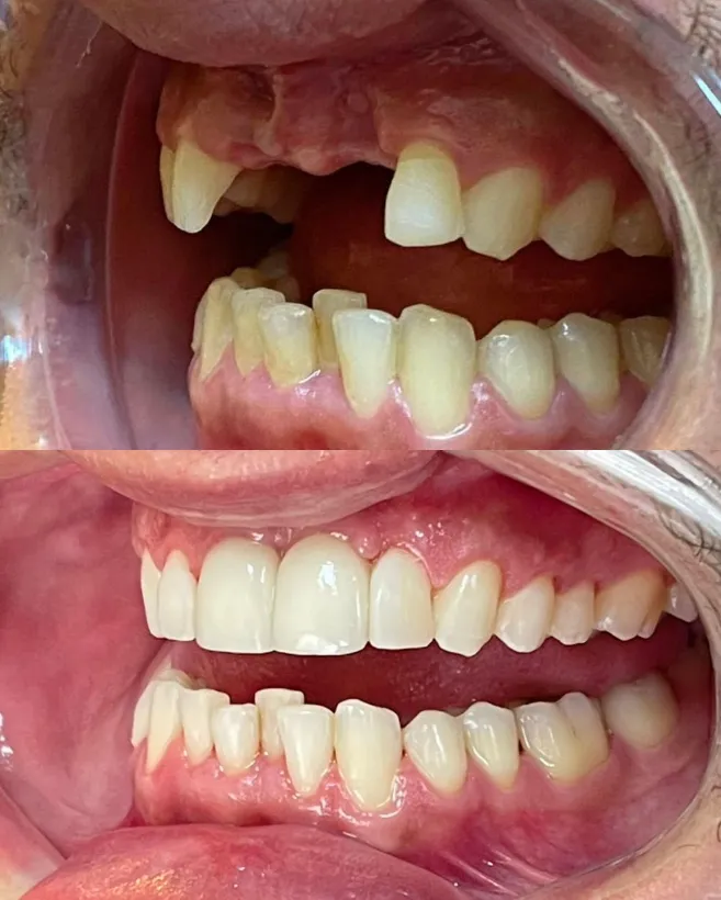 Antes e depois de implante dentário