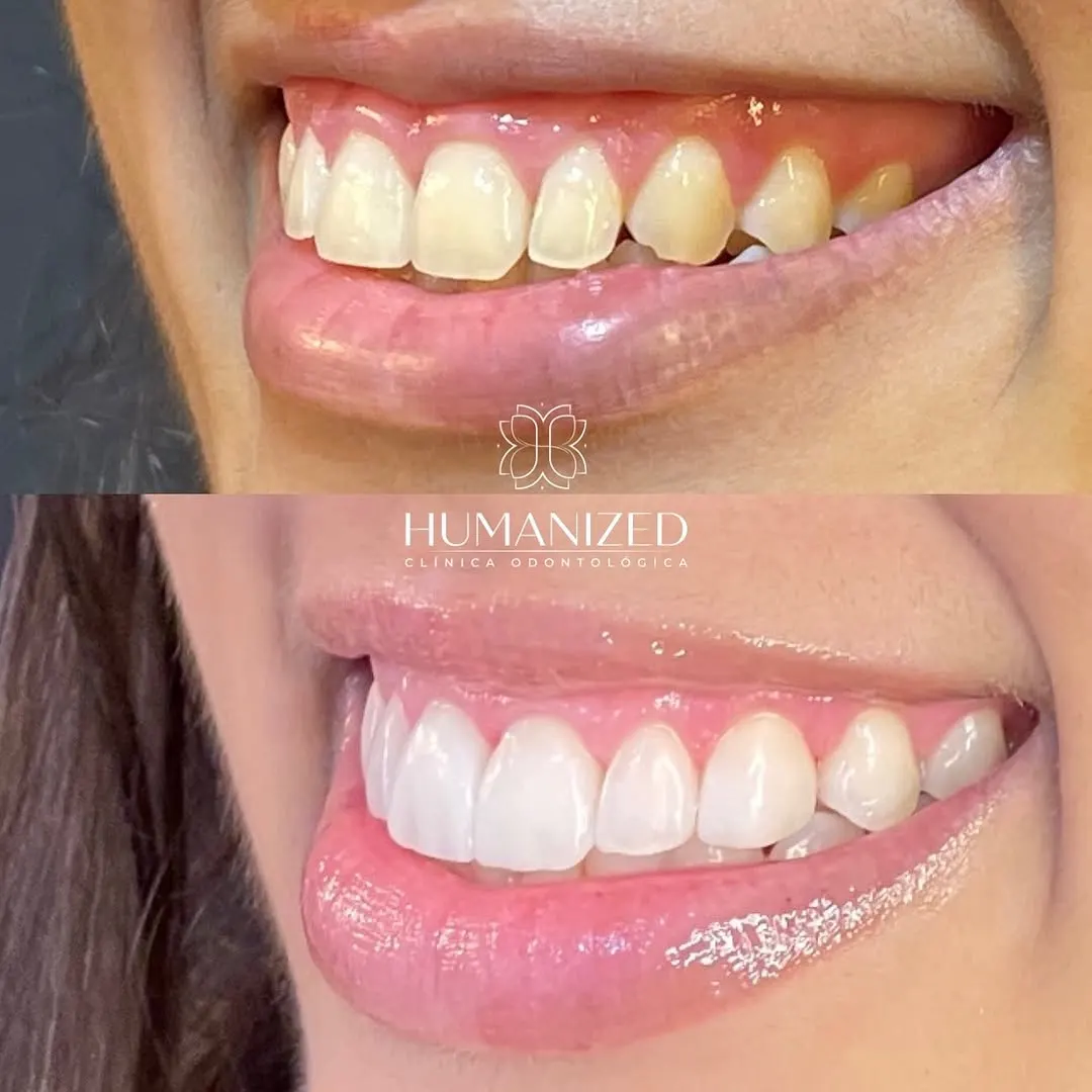 Sorriso de paciente da Humanized antes e depois das facetas dentárias